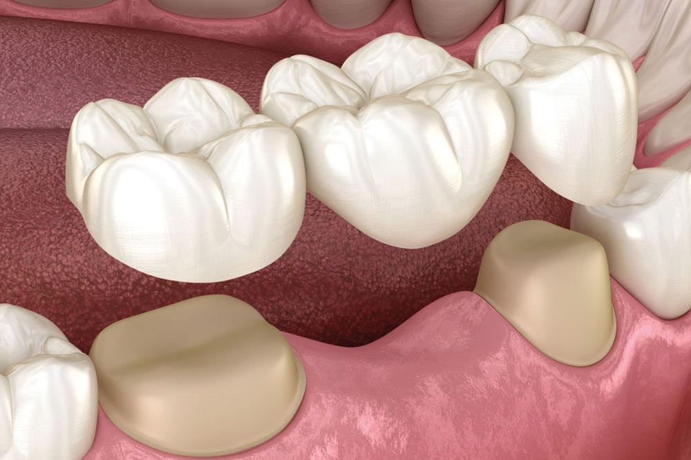 Dental bridge of 3 teeth over molar and premolar