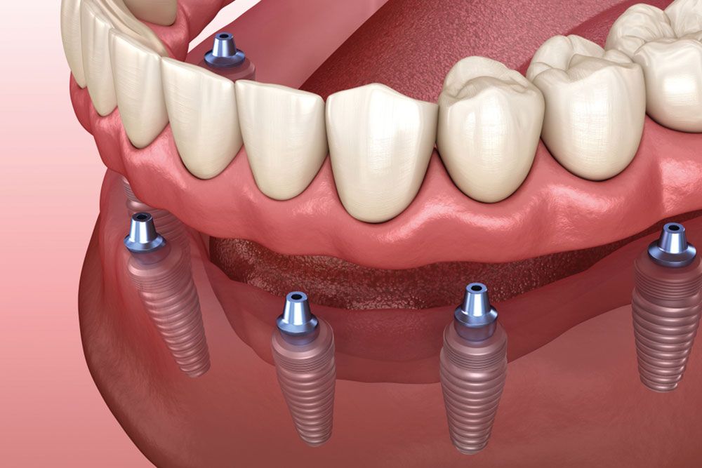 Mandibular prosthesis with gum All on 6 system supported by implants