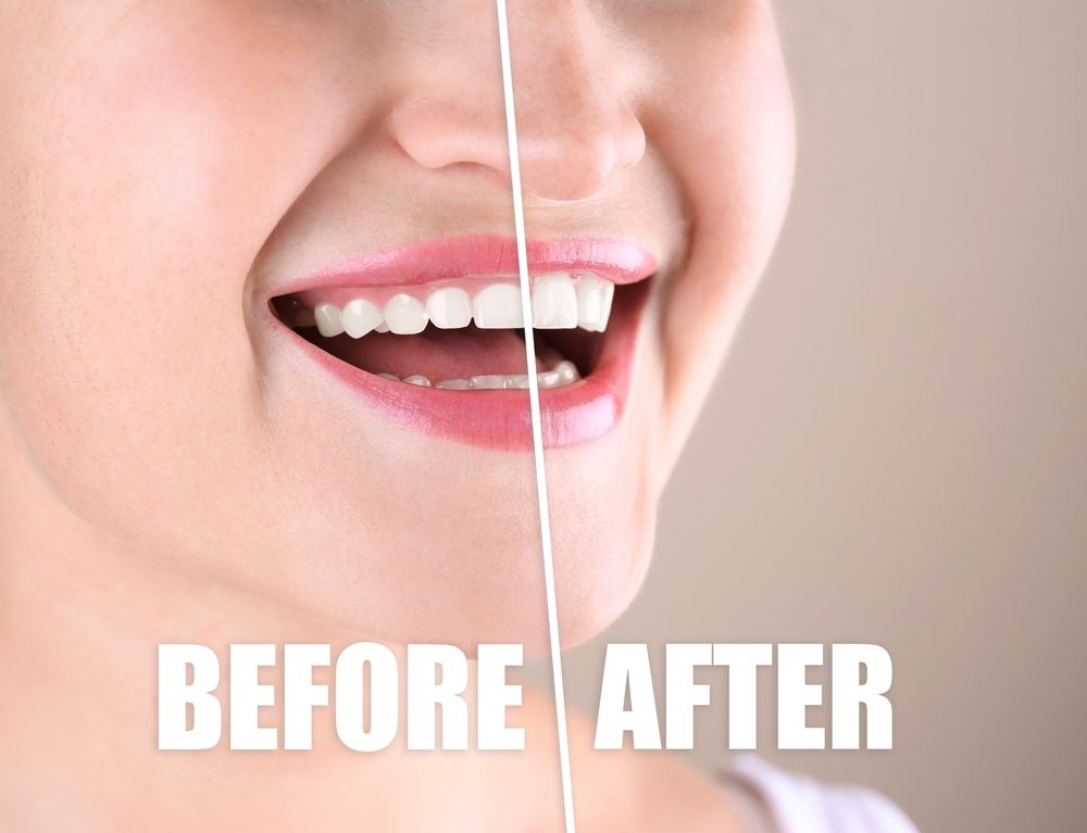 Young woman before and after gingivoplasty procedure on beige background, closeup