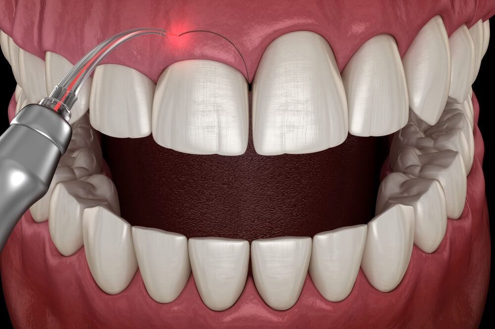 Gingivectomy surgery with laser using