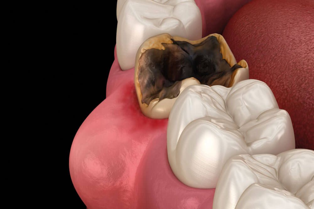 Periodontitis and gum inflammation. Medically accurate dental 3D illustration