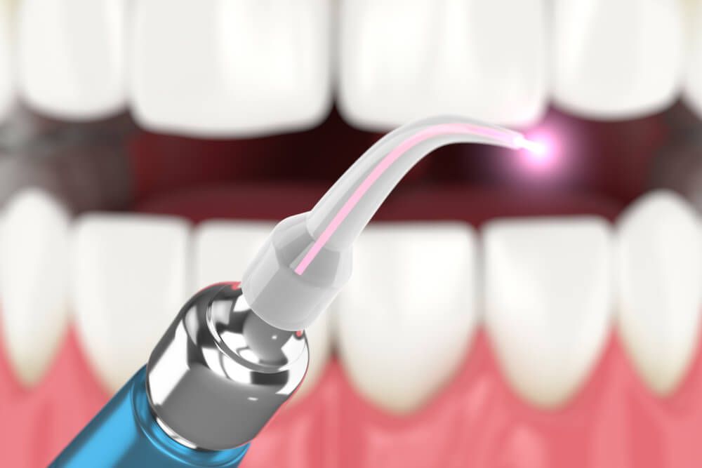 3d render of dental diode laser used to treat gums