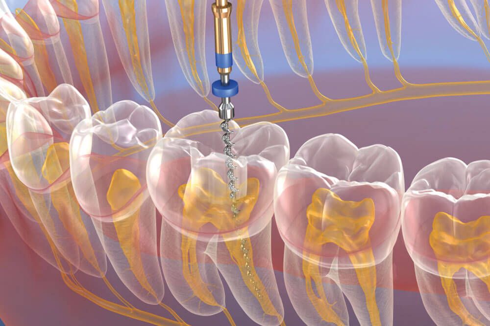 Endodontic root canal treatment process