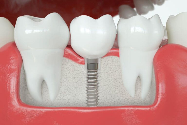 Healthy vs Tooth implant - 3D Rendering