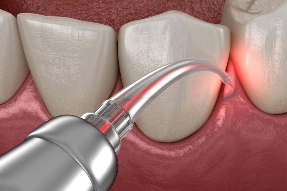 Gum correction surgery with laser.